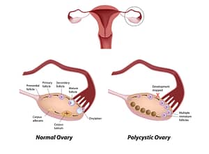 picture of PCOS polycystic ovarian syndrome cysts on the ovaries