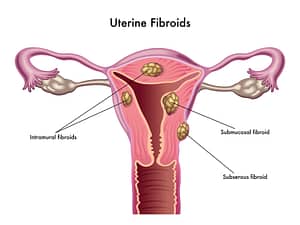 uterine fibroids leiomyoma myomatous uterus