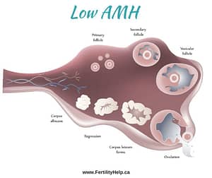 picture of ovaries with low AMH, causes of Low AMH, low ovarian reserve