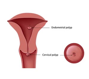 picture of cervical or endometrial or uterine polyps