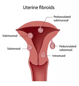 uterine fibroid showing submucosal, subserosal and intramural fibroids