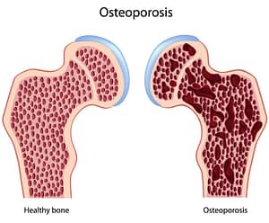picture of bones showing healthy bone, osteoporosis and osteopenia