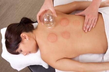 woman having cupping treatment