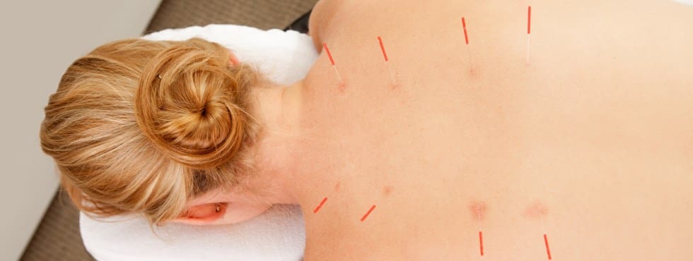 picture showing Acupuncture for back pain or neck pain or acupuncture for fertility, acupuncture for IVF